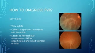 HOW TO DIAGNOSE PVR?
Early Signs:
• Very subtle
• Cellular dispersion in vitreous
and on retina
• Localised fibrocellular
membranes – White
opacification and small wrinkles
or folds
 