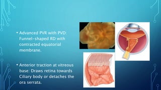 • Advanced PVR with PVD:
Funnel-shaped RD with
contracted equatorial
membrane.
• Anterior traction at vitreous
base: Draws retina towards
Ciliary body or detaches the
ora serrata.
 