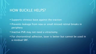 HOW BUCKLE HELPS?
• Supports vitreous base against the traction
• Prevents leakage from new or small missed retinal breaks in
periphery
• Inactive PVR may not need a vitrectomy.
• For chorioretinal adhesion, laser is better but cannot be used in
a residual SRF.
 