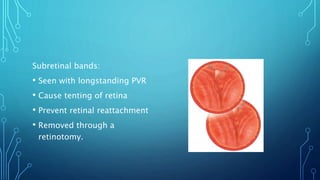 Subretinal bands:
• Seen with longstanding PVR
• Cause tenting of retina
• Prevent retinal reattachment
• Removed through a
retinotomy.
 