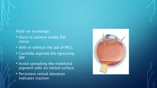 Fluid-air exchange:
• Done to achieve totally flat
retina
• With or without the aid of PFCL
• Carefully aspirate the egressing
SRF
• Avoid spreading the mobilized
pigment cells on retinal surface
• Persistent retinal elevation
indicates traction
 