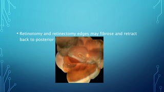 • Retinotomy and retinectomy edges may fibrose and retract
back to posterior pole
 