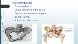 Fault in the passage
 Contracted pelvic
 Undue resistance of the pelvic
floor or perineum due to spam
or old scarring.
 Soft tissue pelvic tumor.
 
