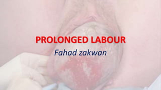 PROLONGED LABOUR
Fahad zakwan
 