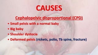 CAUSES
Cephalopelvic disproportional (CPD)
• Small pelvis with a normal baby
• Big baby
• Shoulder dystocia
• Deformed pelvis (rickets, polio, Tb spine, fracture)
 
