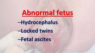 Abnormal fetus
–Hydrocephalus
–Locked twins
–Fetal ascites
 
