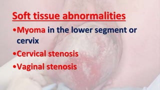 Soft tissue abnormalities
•Myoma in the lower segment or
cervix
•Cervical stenosis
•Vaginal stenosis
 