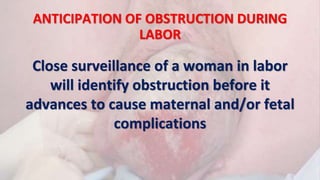ANTICIPATION OF OBSTRUCTION DURING
LABOR
Close surveillance of a woman in labor
will identify obstruction before it
advances to cause maternal and/or fetal
complications
 