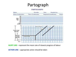Partograph
ALERT LINE – represent the mean rate of slowest progress of labour
ACTION LINE – appropriate action should be taken
 