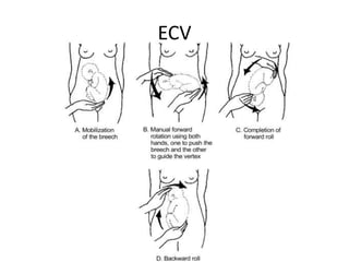 ECV
 