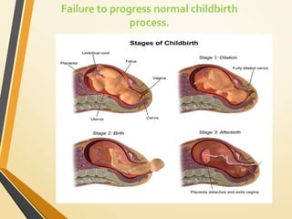 Failure to progress normal childbirth
process.
 
