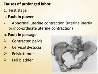 Causes of prolonged labor
1. First stage
a. Fault in power
 Abnormal uterine contraction (uterine inertia
or inco-ordinate uterine contraction)
b. Fault in passage
 Contracted pelvis
 Cervical dystocia
 Pelvic tumor
 Full bladder
 
