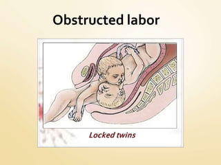 Obstructed labor
 
