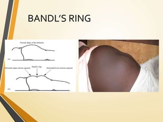 BANDL’S RING
 