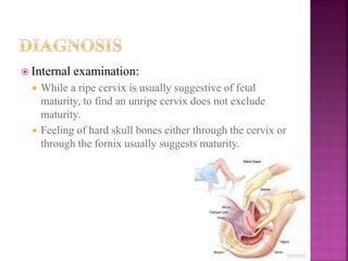 Internal examination:
 While a ripe cervix is usually suggestive of fetal
maturity, to find an unripe cervix does not exclude
maturity.
 Feeling of hard skull bones either through the cervix or
through the fornix usually suggests maturity.
 