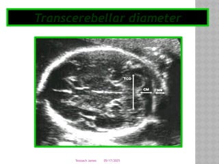 05/17/2025
Tesloach James
Transcerebellar diameter
 