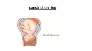 constriction ring
 