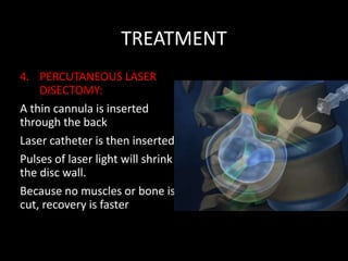 TREATMENT
4. PERCUTANEOUS LASER
DISECTOMY:
A thin cannula is inserted
through the back
Laser catheter is then inserted
Pulses of laser light will shrink
the disc wall.
Because no muscles or bone is
cut, recovery is faster
 