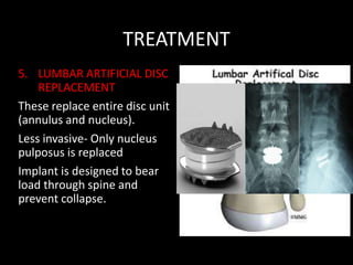 TREATMENT
5. LUMBAR ARTIFICIAL DISC
REPLACEMENT
These replace entire disc unit
(annulus and nucleus).
Less invasive- Only nucleus
pulposus is replaced
Implant is designed to bear
load through spine and
prevent collapse.
 