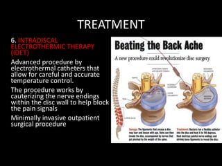 TREATMENT
6. INTRADISCAL
ELECTROTHERMIC THERAPY
(IDET)
Advanced procedure by
electrothermal catheters that
allow for careful and accurate
temperature control.
The procedure works by
cauterizing the nerve endings
within the disc wall to help block
the pain signals
Minimally invasive outpatient
surgical procedure
 