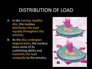 DISTRIBUTION OF LOAD
A. In the normal, healthy
disc, the nucleus
distributes the load
equally throughout the
annulus.
B. As the disc undergoes
degeneration, the nucleus
loses some of its
cushioning ability and
transmits the load
unequally to the annulus.
 