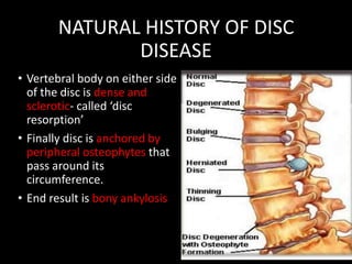 NATURAL HISTORY OF DISC
DISEASE
• Vertebral body on either side
of the disc is dense and
sclerotic- called ‘disc
resorption’
• Finally disc is anchored by
peripheral osteophytes that
pass around its
circumference.
• End result is bony ankylosis
 
