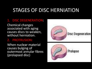 STAGES OF DISC HERNIATION
1. DISC DEGENERATION:
Chemical changes
associated with aging
causes discs to weaken,
without herniation.
2. PROTRUSION:
When nuclear material
causes bulging of
outermost annular fibres
(prolapsed disc)
 