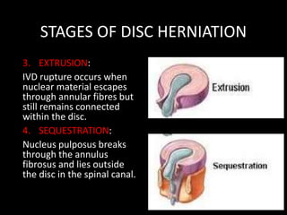 STAGES OF DISC HERNIATION
3. EXTRUSION:
IVD rupture occurs when
nuclear material escapes
through annular fibres but
still remains connected
within the disc.
4. SEQUESTRATION:
Nucleus pulposus breaks
through the annulus
fibrosus and lies outside
the disc in the spinal canal.
 