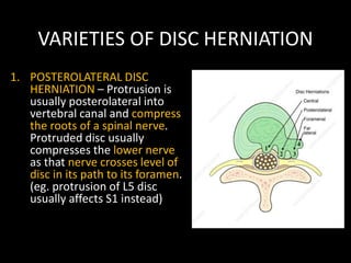VARIETIES OF DISC HERNIATION
1. POSTEROLATERAL DISC
HERNIATION – Protrusion is
usually posterolateral into
vertebral canal and compress
the roots of a spinal nerve.
Protruded disc usually
compresses the lower nerve
as that nerve crosses level of
disc in its path to its foramen.
(eg. protrusion of L5 disc
usually affects S1 instead)
 