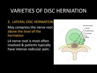 VARIETIES OF DISC HERNIATION
3. LATERAL DISC HERNIATION:
May compress the nerve root
above the level of the
herniation
L4 nerve root is most often
involved & patients typically
have intense radicular pain.
 