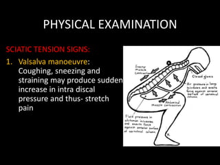 PHYSICAL EXAMINATION
SCIATIC TENSION SIGNS:
1. Valsalva manoeuvre:
Coughing, sneezing and
straining may produce sudden
increase in intra discal
pressure and thus- stretch
pain
 