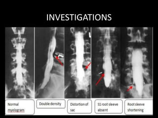 INVESTIGATIONS
MYELOGRAPHY
Currently outdated
Water soluble contrast compounds- 3 to 5ml of solution
injected into sub-arachnoid space followed by Xray.
Typical appearance:
1. Lateral indentation and deformation of contrast
column by posterolateral disc
2. Hourglass deformity from midline herniation
3. Root pouch filling defects
4. Complete or partial blocks at the level of disc
 