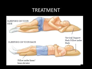 TREATMENT
Lying in SEMI-FOWLER position
OR
On the side with both hips and knee flexed with a
pillow between the legs- relieves pressure on disc
Pelvic or skin traction may also be used
 