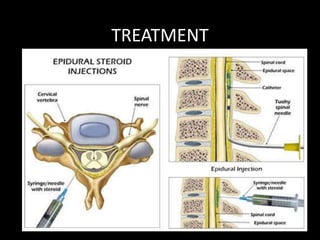 TREATMENT
4. EPIDURAL STEROID:
Provides long pain relief without excessive narcotic
intake.
Usually used is-
Methylprednisolone (80-120mg)/ Triamcinolone (40mg)
WITH
2% Xylocaine mixed with NS to make 10cc
Acts by reducing inflammation around affected nerve
root.
 