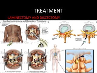 TREATMENT
LAMINECTOMY AND DISCECTOMY
 
