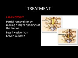 TREATMENT
LAMINOTOMY
Partial removal (or by
making a larger opening) of
the lamina.
Less invasive than
LAMINECTOMY
 