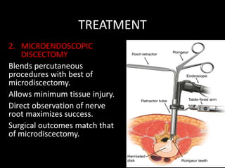 TREATMENT
2. MICROENDOSCOPIC
DISCECTOMY
Blends percutaneous
procedures with best of
microdiscectomy.
Allows minimum tissue injury.
Direct observation of nerve
root maximizes success.
Surgical outcomes match that
of microdiscectomy.
 