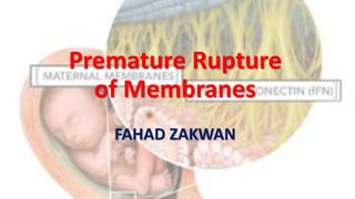 Premature Rupture
of Membranes
FAHAD ZAKWAN
 