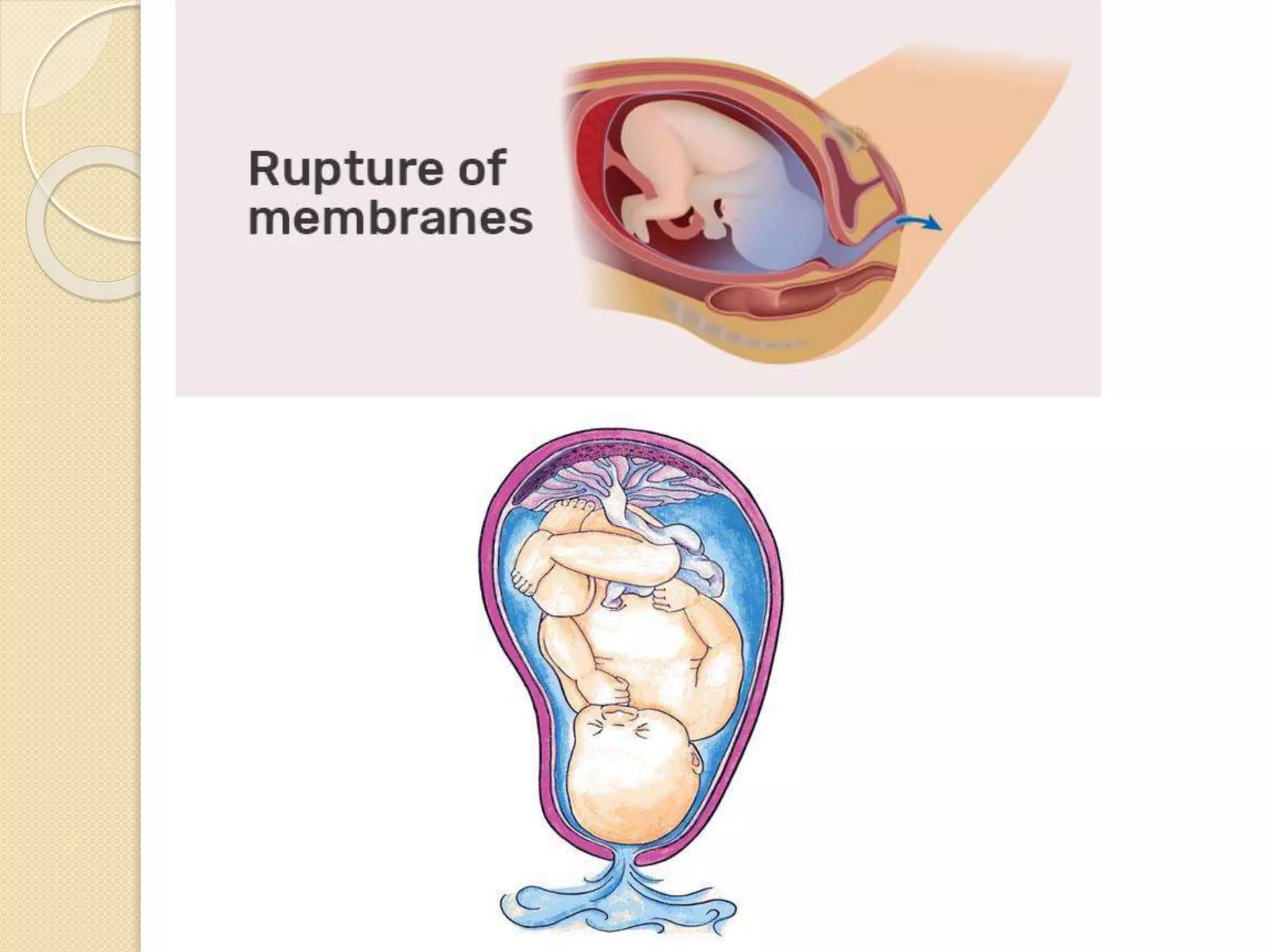 Fresh Look at Pre Labor Rupture Of Membranes Prom