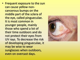 • Frequent exposure to the sun
can cause yellow non-
cancerous bumps on the
middle part of the sclera of
the eye, called pingueculae.
It is most common in
younger people, mainly
those who spend a lot of
their time outdoors and do
not protect their eyes from
UV rays. To decrease the risk
of developing pingueculae, it
may be wise to wear
sunglasses when outdoors,
even on overcast days.
 