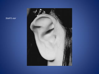 Stahl’s ear
 