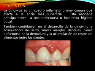 GINGIVITIS
La gingivitis es un cuadro inflamatorio muy común que
afecta a la encía más superficial. Está asociada
principalmente a una defectuosa o incorrecta higiene
bucal.
También contribuyen en el desarrollo de la gingivitis la
acumulación de sarro, malas arreglos dentales, cierre
defectuoso de la dentadura y la acumulación de restos de
alimentos entre los dientes.
 