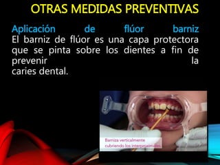OTRAS MEDIDAS PREVENTIVAS
Aplicación de flúor barniz
El barniz de flúor es una capa protectora
que se pinta sobre los dientes a fin de
prevenir la
caries dental.
 