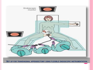 SET UP FOR TRANSVAGINAL APPENDECTOMY USING FLEXIBLE ENDOSCOPIC INSTRUMENTATION
 