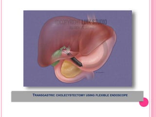 TRANSGASTRIC CHOLECYSTECTOMY USING FLEXIBLE ENDOSCOPE
 