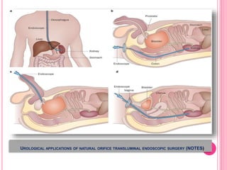 UROLOGICAL APPLICATIONS OF NATURAL ORIFICE TRANSLUMINAL ENDOSCOPIC SURGERY (NOTES)
 