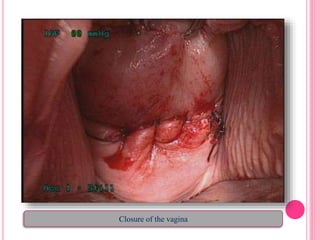 Closure of the vagina
 