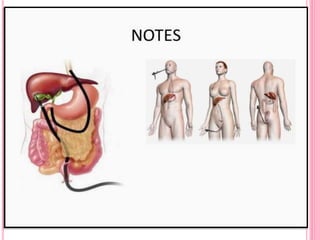 SURGERY THROUGH BODY’S NATURAL OPENINGS LIKE MOUTH, VAGINA,
 