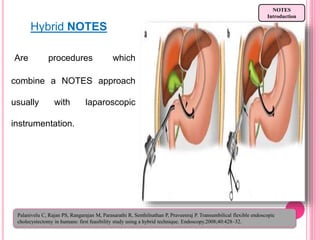 Hybrid NOTES
Are procedures which
combine a NOTES approach
usually with laparoscopic
instrumentation.
NOTES
Introduction
Palanivelu C, Rajan PS, Rangarajan M, Parasarathi R, Senthilnathan P, Praveenraj P. Transumbilical flexible endoscopic
cholecystectomy in humans: first feasibility study using a hybrid technique. Endoscopy.2008;40:428–32.
 