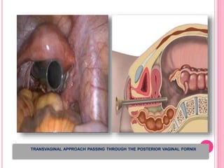 TRANSVAGINAL APPROACH PASSING THROUGH THE POSTERIOR VAGINAL FORNIX
 